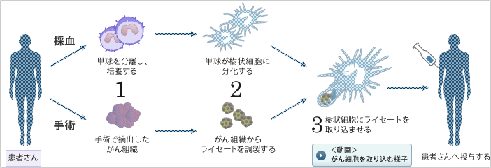 樹状細胞ワクチン療法（DCワクチン療法）